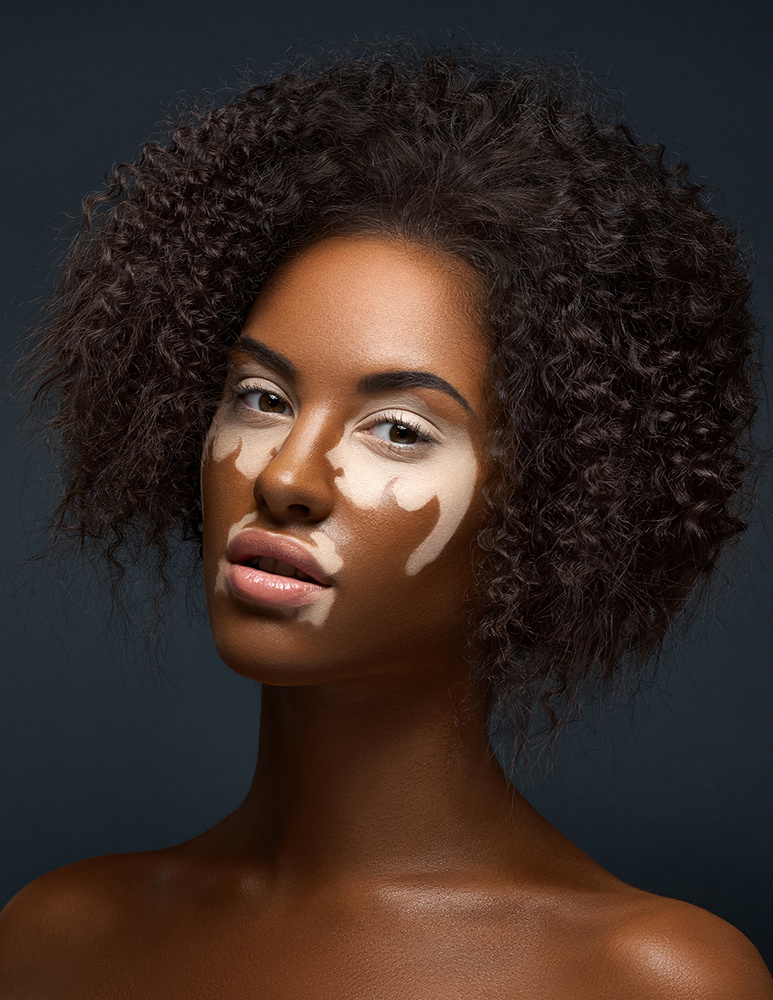 Vitiligo von Alex Malikov